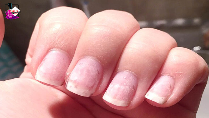 کاشت ناخن و قارچ